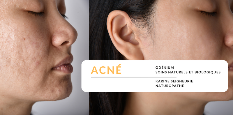 ACNÉ: COMMENT PRENDRE SOIN DE SA PEAU AU QUOTIDIEN?